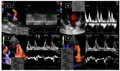 Color M-Mode Echocardiography for Non-Invasive Assessment of the Intraventricular Pressure in Dogs Before and After Ductus Arteriosus Occlusion: A Retrospective Study